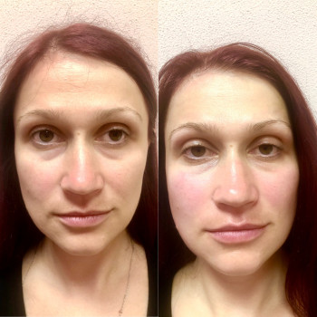 посля 1процедури скульптурного ліфтингу.