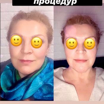 Результат після 8 процедур