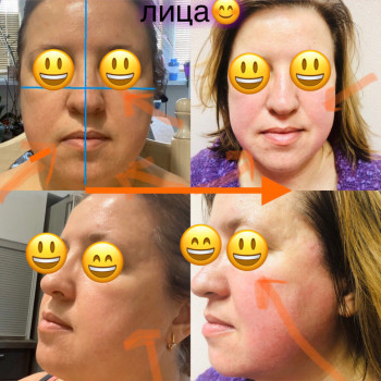 Результат після 5 процедур