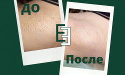 Лазерная эпиляция Косметолог Анастасия Петухова Одесса