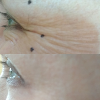 Работа ботулотоксином.Гусиные лапки через 2 недели после про