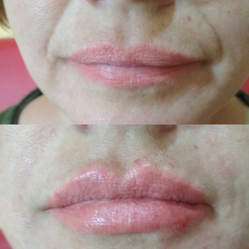 Коррекция формы губ ( ассиметрия) и носогубных складок. Styl