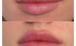 Увеличение губ Косметолог-инъекционист Наталия Одесса