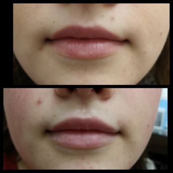 Увеличение губ
                    Косметолог-ін'єкціоніст Наталия Одеса
