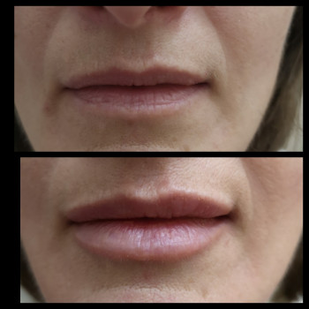 Увеличение губ
                    Косметолог-ін'єкціоніст Наталия Одеса