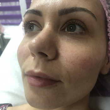 Коррекция скуловой зоны