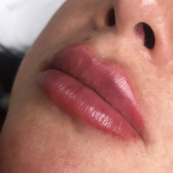 Аугментация губ
