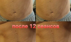 Кавитация Косметолог Сергей Запоріжжя