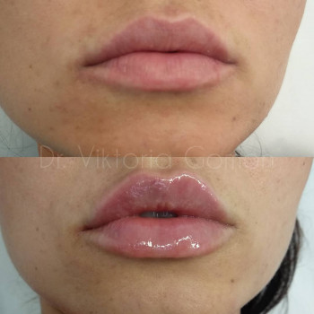 Контурна пластика губ
                    Косметологічний центр Dr. Gomon Cosmetology Черкаси