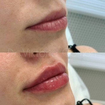 Контурна пластика губ
                    Косметологічний центр Dr. Gomon Cosmetology Черкаси