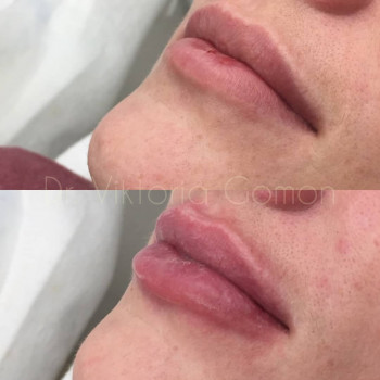 Контурна пластика губ
                    Косметологічний центр Dr. Gomon Cosmetology Черкаси