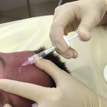 Лечение динамический морщин.