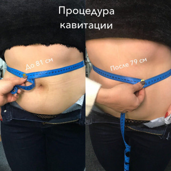 Кавитация
                    Косметолог Анна Викторовская Днепр