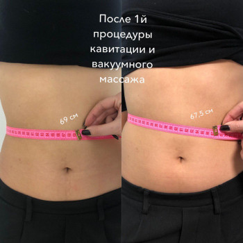 Кавитация
                    Косметолог Анна Викторовская Днепр