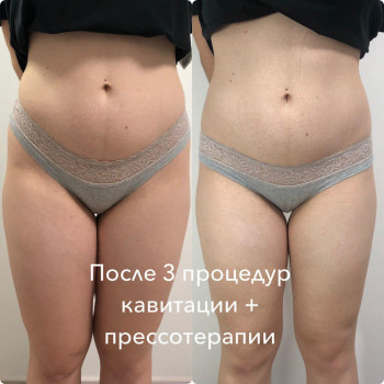 Кавитация
                    Косметолог Анна Викторовская Днепр