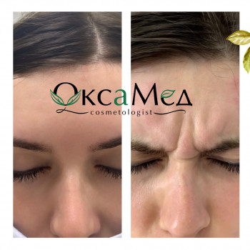 Процедура ботулінотерапії