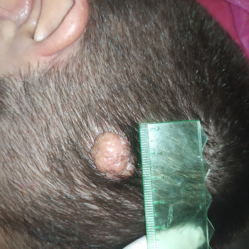 Дермальный невус