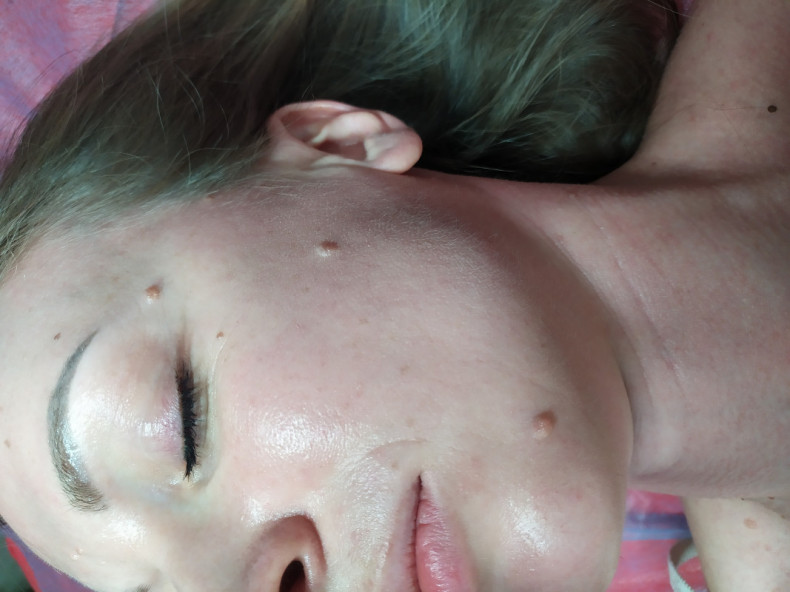 Дермальные невусы.по 30 гр за удаление каждой, фото -  