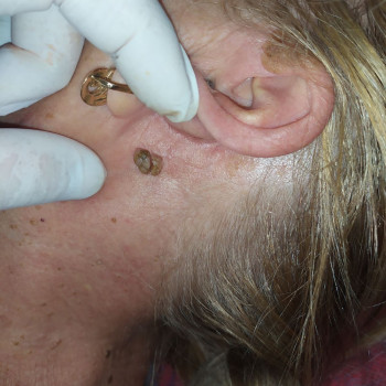 Дермальный невус