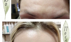Ботокс Ботулинотерапия Botox Косметолог-инъекционист Наталия Одесса