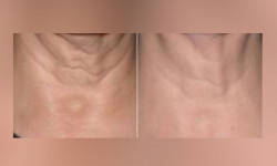 RF лифтинг Косметологический центр Косметологический центр Марии Надыч Херсон