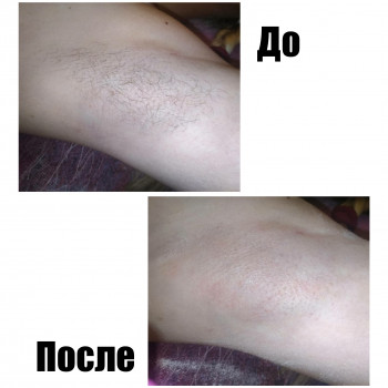 До/после

Зона"подмышечные впадины"

Ваш мастер - кристина