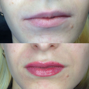 Исправление асимметрии губ