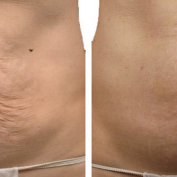 Smas - лифтинг
                    Косметологический центр Косметологический центр Марии Надыч Херсон