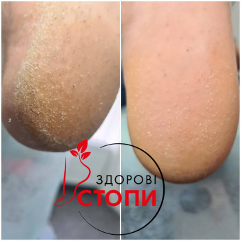 Обробка гіперкератозу