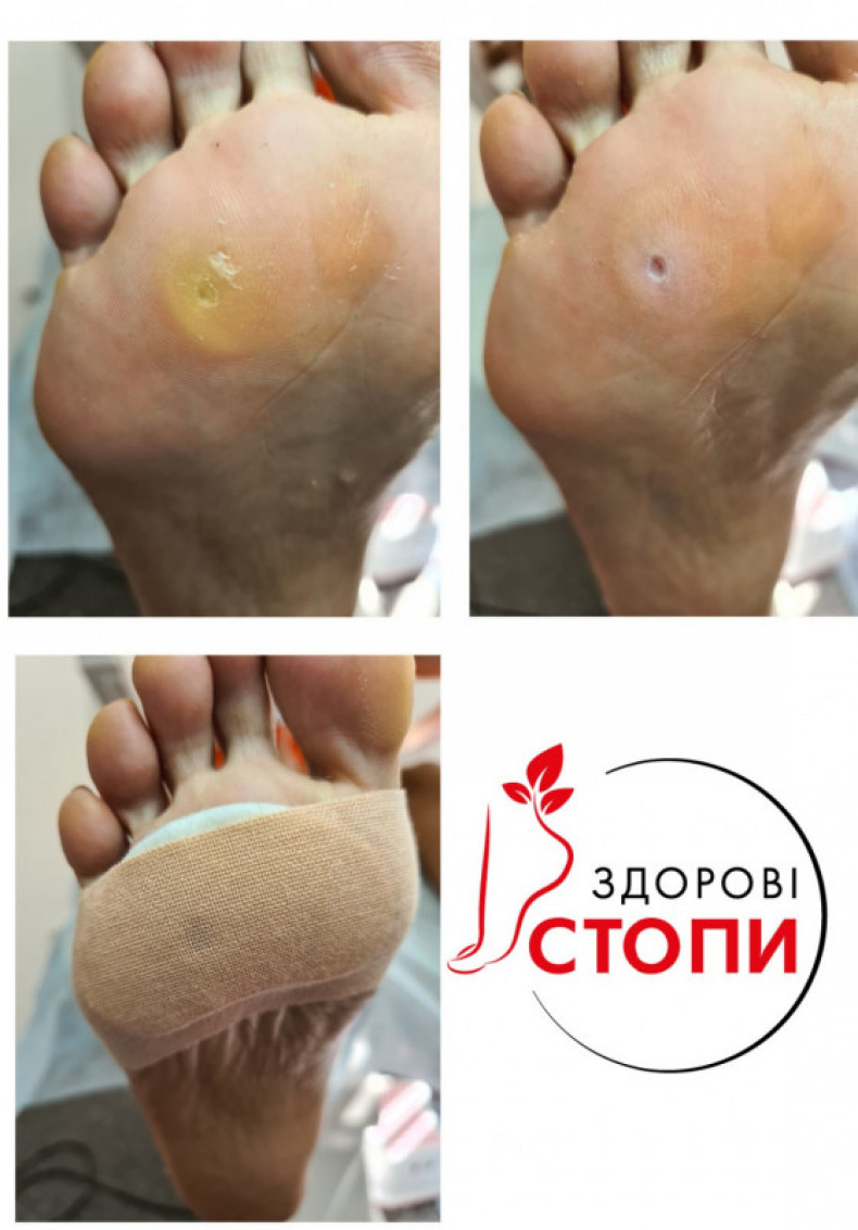Удаление мозоли., фото -  