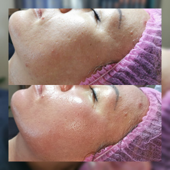 Пилинг ABR Holy Land
                    Врач-косметолог Наталия Сумы