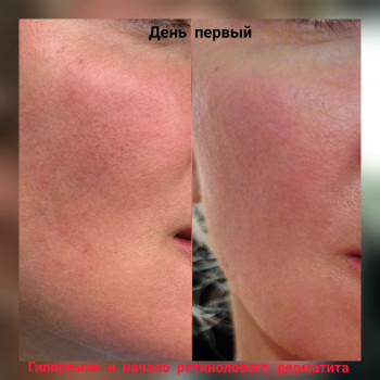 Жёлтый пилинг
                    Врач-косметолог Наталия Сумы