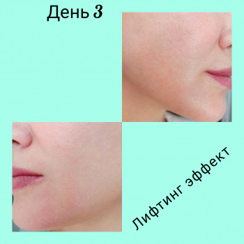 Жёлтый пилинг
                    Врач-косметолог Наталия Сумы