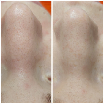 HydraFacial (гидрополинг)
                    Косметолог Светлана Харьков