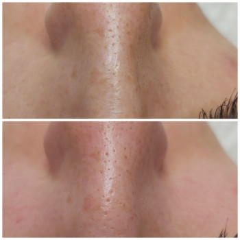 HydraFacial (гидрополинг)
                    Косметолог Светлана Харьков