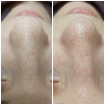 HydraFacial (гидрополинг)
                    Косметолог Светлана Харьков