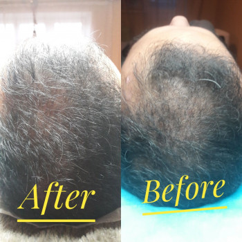 Результат до и после 3 процедур плазмотерапии.