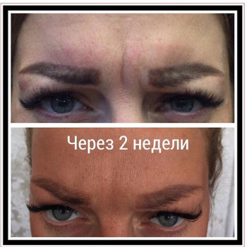 Ботулинотерапия ☘️

Эффект через 2 недели - можно заметить