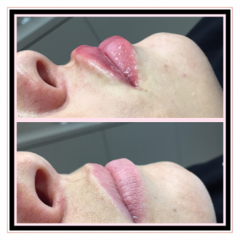 Контурная пластика губ