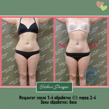 Бодипластика
                    СПА-салон Новая Фигура Запорожье