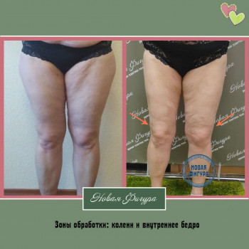 Бодипластика
                    СПА-салон Новая Фигура Запорожье