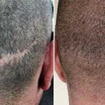 Татуировки любой сложности. Перекрытие шрамов
                    Тату мастер Александр Викторович Запорожье