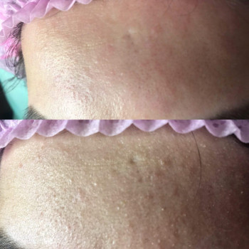 мікродермабразія