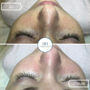 Чистка лица с использованием косметики DMK
                    Салон красоты IDN Beauty Salon & Clinic Киев