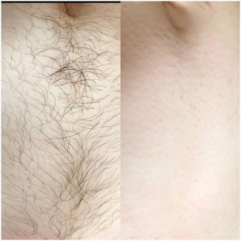 Шугаринг
                    Майстер депіляції Людмила Патлатюк Одеса