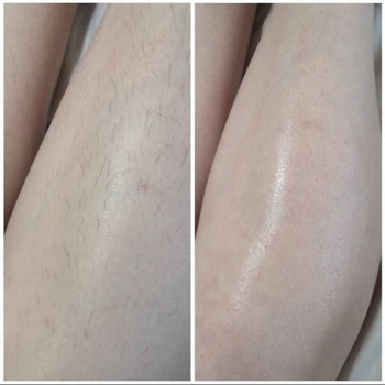 Шугаринг
                    Майстер депіляції Людмила Патлатюк Одеса