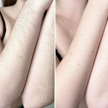 Шугаринг
                    Майстер депіляції Людмила Патлатюк Одеса