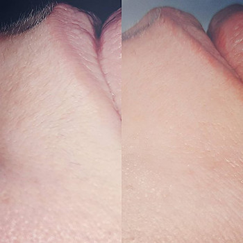 Шугаринг
                    Майстер депіляції Людмила Патлатюк Одеса