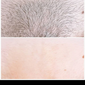 Шугаринг
                    Майстер депіляції Людмила Патлатюк Одеса