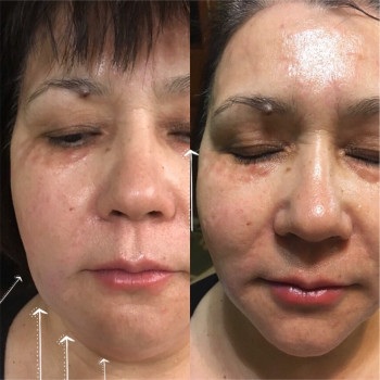 коррекция лица нитями